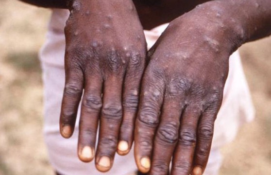 Monkey pox outbreak, fear grips Delta residents