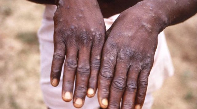 Monkey Pox recorded in Ekiti